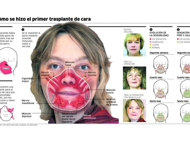 Aurpegiko transplanteak: horrenbesterako al da?